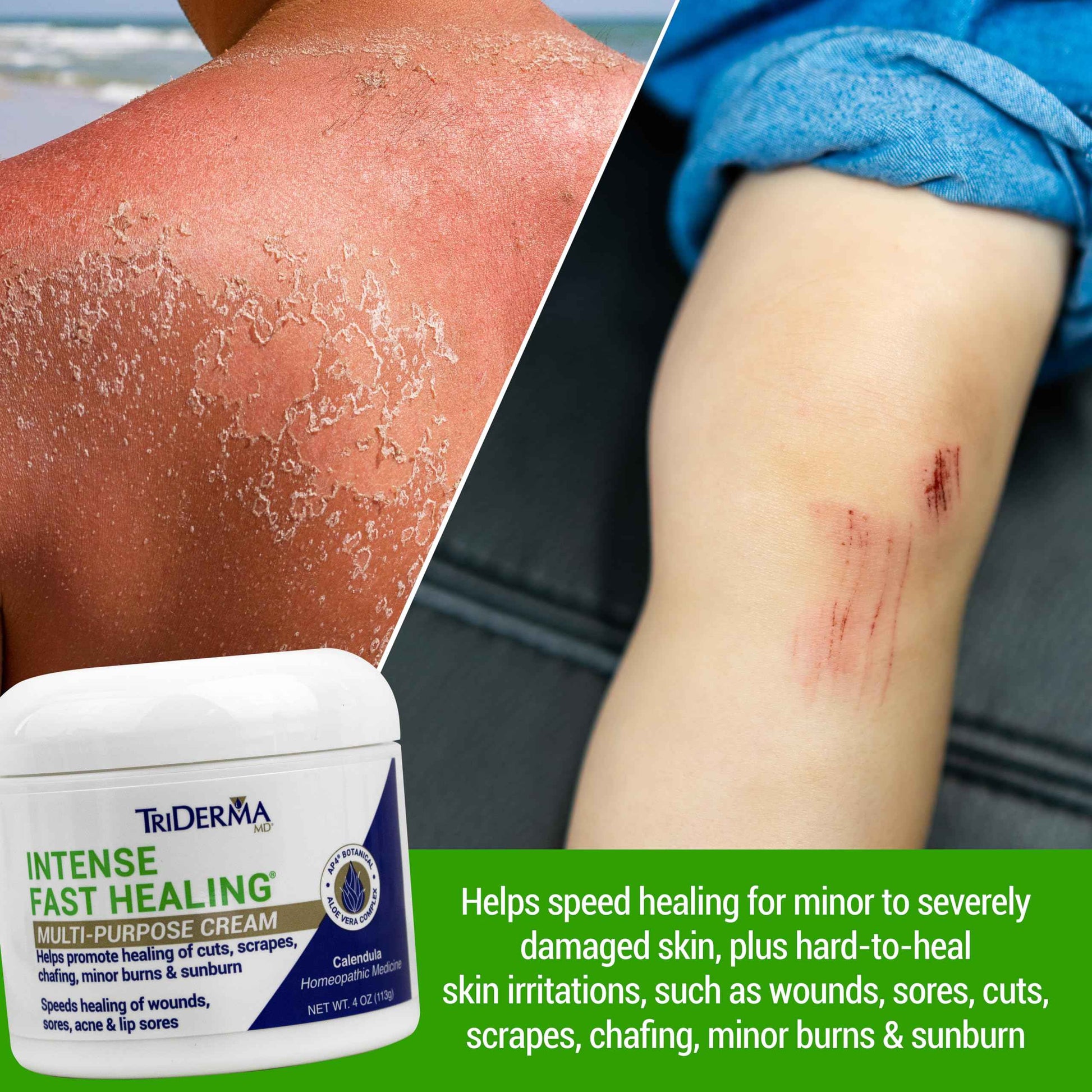 TriDerma Intense Fast Healing Cream, Decreases Healing Time for Minor Irritations, Rashes, Scrapes, Cuts 4 Ounces