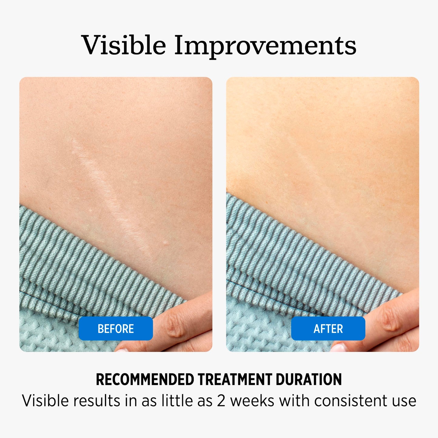 NUVADERMIS Overnight Intensive Scar Cream with Retinol, Allantoin, Vitamin E, Betaine – 1.35 Fl Oz PM Scar Cream Treatment for C-Sections, Keloids & Post-Surgery Care