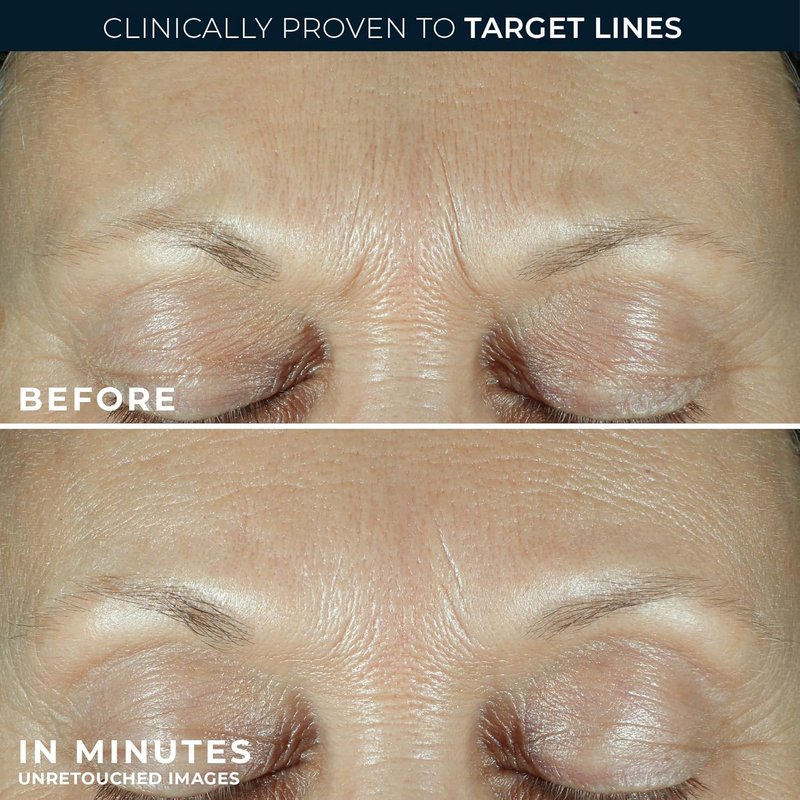 RoC Advanced Retinol Serum - Hyaluronic Acid Wrinkle Filler for Crow's Feet & Laugh Lines | 0.5 fl oz